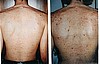 Microdermabrasion